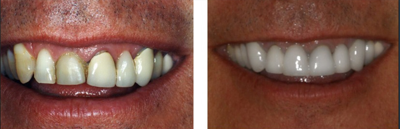 before and after dental implants