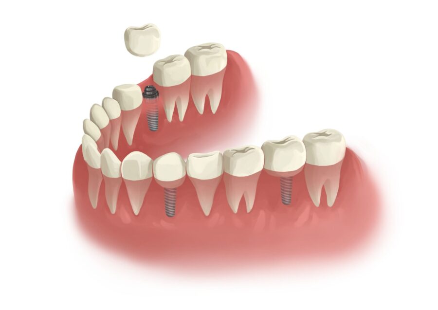 Illustration of a lower arch of teeth with 3 dental implants to replace missing teeth