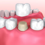 dental crowns, Dental crown installation process, Medically accurate 3d illustration