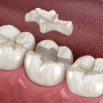 dental fillings, safety of dental fillings