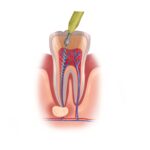 multiple root canals, root canal safety, root canal procedure, dental health, Blue Apple Dental Group, Rohnert Park, root canal recovery, dental care