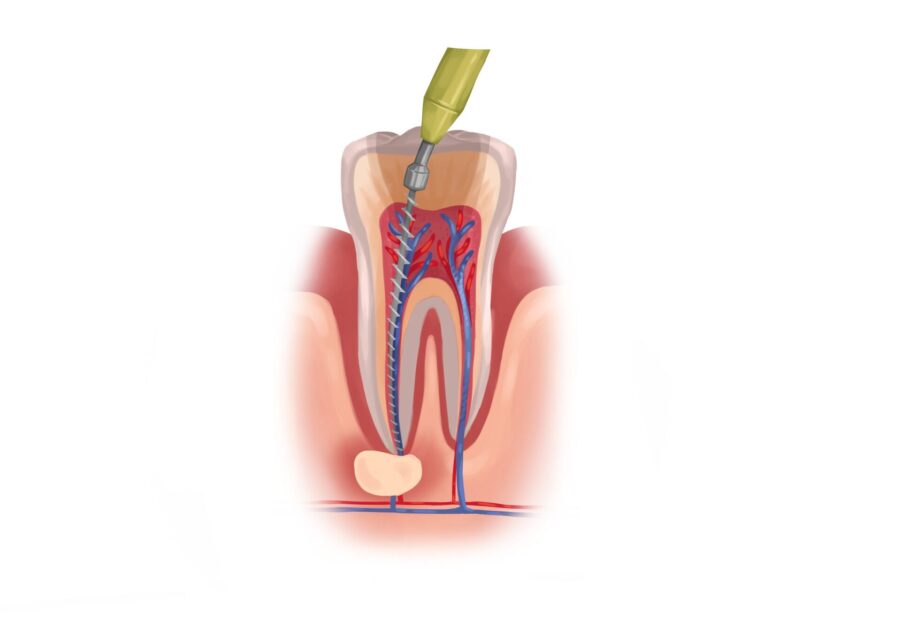 multiple root canals, root canal safety, root canal procedure, dental health, Blue Apple Dental Group, Rohnert Park, root canal recovery, dental care