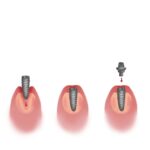 dental implant treatment plan