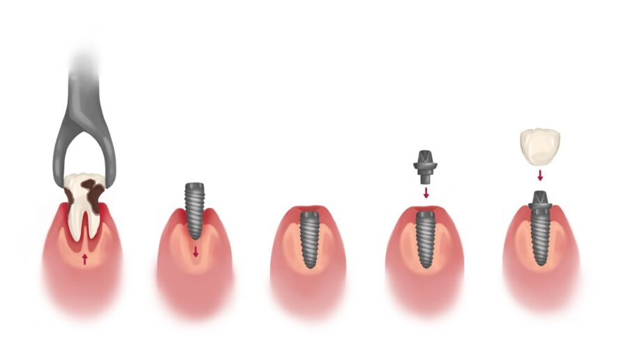 dental implant treatment plan